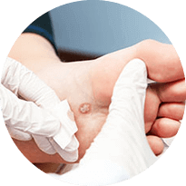 Foot Wart Treatment in the Issaquah, WA 98027