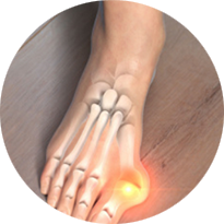 Lapiplasty® 3D Bunion Correction Lapiplasty® 3D Bunion Correction to the Foot and Ankle, Lapiplasty® 3D Bunion Correction in the Issaquah, WA 98027