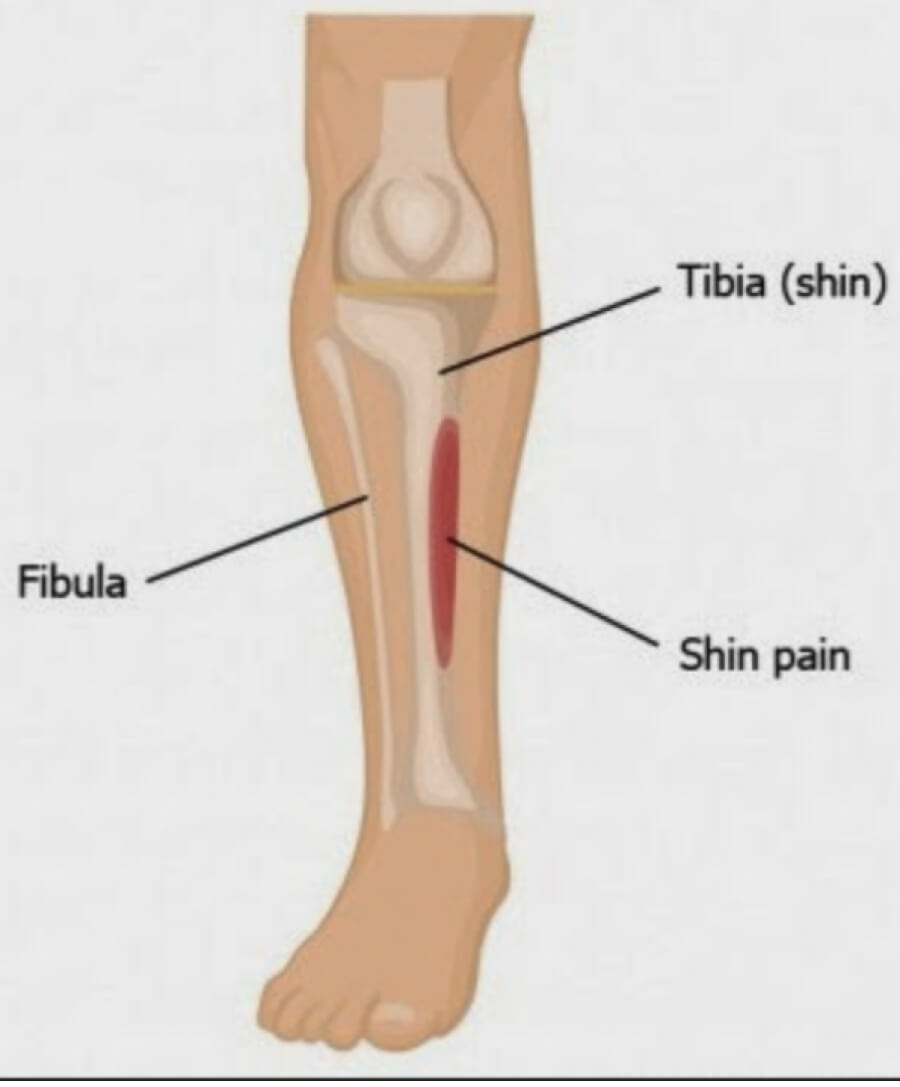 Shin Splints Treatment  Medial Tibial Stress Syndrome