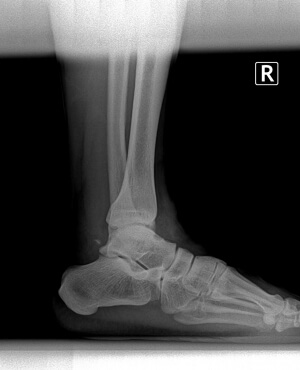 preoperative bunion and tailor's bunion